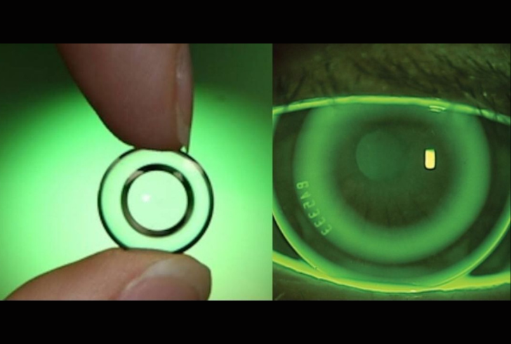 Overnight Lenses for better vision while sleeping.